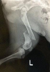 Fracture requiring Orthopedic Surgery
