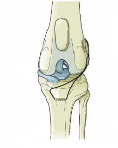 Extracapsular Suture Repair